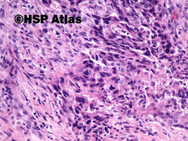8. Rak anaplastyczny (anaplastic carcinoma), 20x