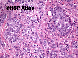 9. Rak anaplastyczny (anaplastic carcinoma), 20x