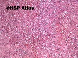 1. Naczyniakomięsak (angiosarcoma), 4x