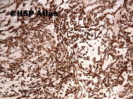 10. Angiosarcoma, CD34, 4x