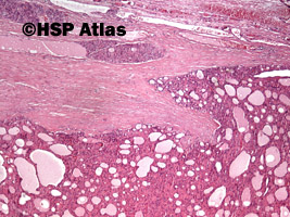 1. Rak pęcherzykowy, typ oksyfilny (follicular carcinoma-oxyphilic cell type), 4x