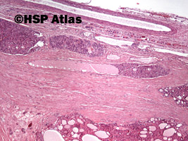 3. Rak pęcherzykowy, typ oksyfilny (follicular carcinoma-oxyphilic cell type), 4x
