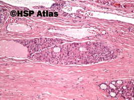 4. Rak pęcherzykowy, typ oksyfilny (follicular carcinoma-oxyphilic cell type), 10x