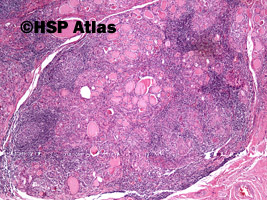1. Przewlekłe limfocytowe zapalenie tarczycy (Hashimoto Thyroiditis), 4x