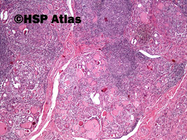 2. Przewlekłe limfocytowe zapalenie tarczycy (Hashimoto Thyroiditis), 4x