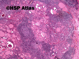 3. Przewlekłe limfocytowe zapalenie tarczycy (Hashimoto Thyroiditis), 4x