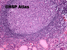 4. Przewlekłe limfocytowe zapalenie tarczycy (Hashimoto Thyroiditis), 10x