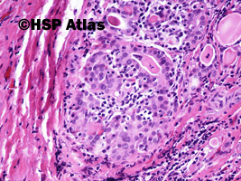 7. Przewlekłe limfocytowe zapalenie tarczycy (Hashimoto Thyroiditis), 20x