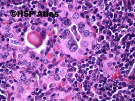 8. Przewlekłe limfocytowe zapalenie tarczycy (Hashimoto Thyroiditis), 40x