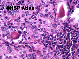 9. Przewlekłe limfocytowe zapalenie tarczycy (Hashimoto Thyroiditis), 40x
