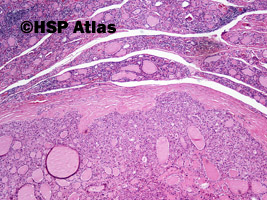 1. Gruczolak z komórek Hürthle'a (Hürthle cell adenoma), 4x