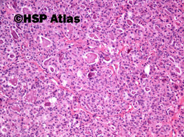 3. Gruczolak z komórek Hürthle'a (Hürthle cell adenoma), 10x