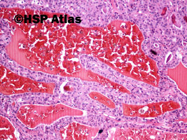 4. Gruczolak z komórek Hürthle'a (Hürthle cell adenoma), 10x