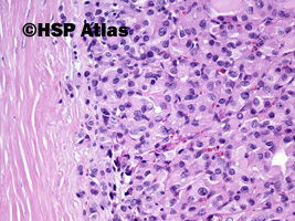 6. Gruczolak z komórek Hürthle'a (Hürthle cell adenoma), 20x