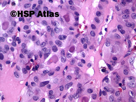 7. Gruczolak z komórek Hürthle'a (Hürthle cell adenoma), 40x