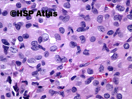 8. Gruczolak z komórek Hürthle'a (Hürthle cell adenoma), 40x
