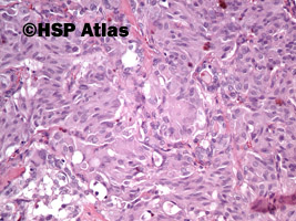 14. Rak rdzeniasty (medullary carcinoma), 20x
