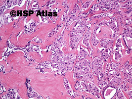 4. Rak rdzeniasty (medullary carcinoma), 10x