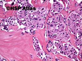 6. Rak rdzeniasty (medullary carcinoma), 20x