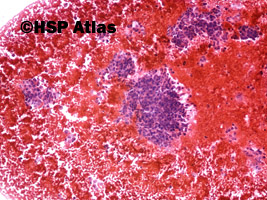 1. Rak rdzeniasty - cytologia (medullary carcinoma - cytology), 10x