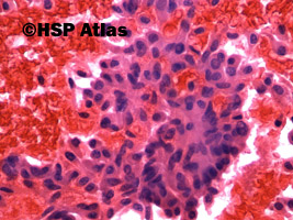 7. Rak rdzeniasty - cytologia (medullary carcinoma - cytology), 40x