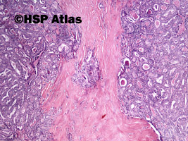 11. Rak brodawkowaty (papillary carcinoma), 4x