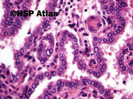 12. Rak brodawkowaty (papillary carcinoma), 40x