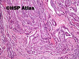 4. Rak brodawkowaty (papillary carcinoma), 10x