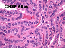 8. Rak brodawkowaty (papillary carcinoma), 40x