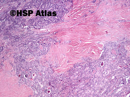 9. Rak brodawkowaty (papillary carcinoma), 4x