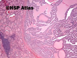 1. Rak brodawkowaty, wariant otorebkowany (papillary carcinoma, encapsulated variant), 4x
