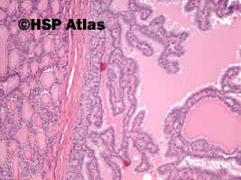 2. Rak brodawkowaty, wariant otorebkowany (papillary carcinoma, encapsulated variant), 10x
