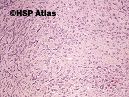 10. Carcinoid - well differnetiated neuroendocrine tumor/neoplasm (NET), 4x