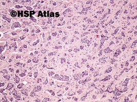 11. Rakowiak [carcinoid - well differnetiated neuroendocrine tumor/neoplasm (NET)], 10x