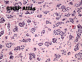 13. Rakowiak [carcinoid - well differnetiated neuroendocrine tumor/neoplasm (NET)], 20x