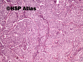 5. Carcinoid - well differnetiated neuroendocrine tumor/neoplasm (NET), 10x