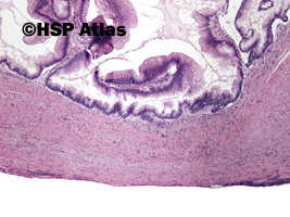 3. Gruczolakotorbielak śluzowy (mucinous cystadenoma), 4x