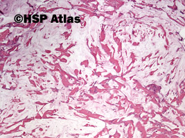 2. Śluzak rzekomy otrzewnej (pseudomyxoma peritonei), 4x