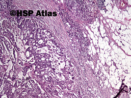 2. Gruczolakorak okrężnicy, G3 (adenocarcinoma of colon, high grade - grade 3), 4x