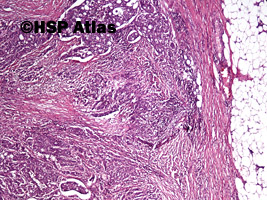 3. Gruczolakorak okrężnicy, G3 (adenocarcinoma of colon, high grade - grade 3), 4x