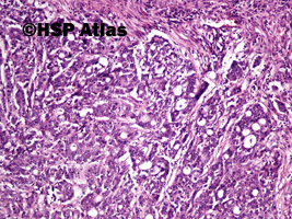 5. Gruczolakorak okrężnicy, G3 (adenocarcinoma of colon, high grade - grade 3), 10x