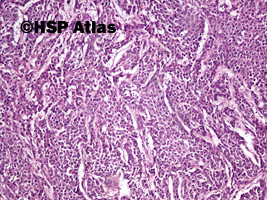 6. Gruczolakorak okrężnicy, G3 (adenocarcinoma of colon, high grade - grade 3), 10x