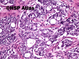 7. Gruczolakorak okrężnicy, G3 (adenocarcinoma of colon, high grade - grade 3), 20x