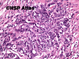 9. Gruczolakorak okrężnicy, G3 (adenocarcinoma of colon, high grade - grade 3), 20x