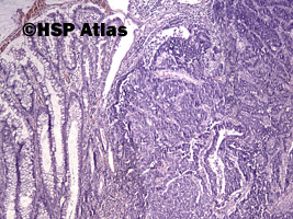 1. Mieszany rak gruczołowo - neuroendokrynny [Mixed adenoneuroendocrine carcinoma (MANEC)], 4x
