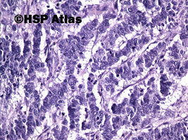 10. Mieszany rak gruczołowo - neuroendokrynny [Mixed adenoneuroendocrine carcinoma (MANEC)], 20x