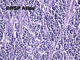 11. Mieszany rak gruczołowo - neuroendokrynny [Mixed adenoneuroendocrine carcinoma (MANEC)], 20x