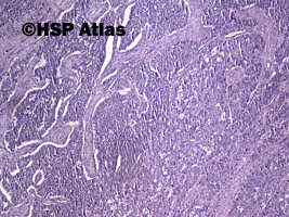 2. Mieszany rak gruczołowo - neuroendokrynny [Mixed adenoneuroendocrine carcinoma (MANEC)], 4x
