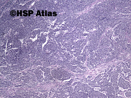 3. Mieszany rak gruczołowo - neuroendokrynny [Mixed adenoneuroendocrine carcinoma (MANEC)], 4x