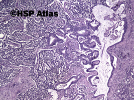 6. Mieszany rak gruczołowo - neuroendokrynny [Mixed adenoneuroendocrine carcinoma (MANEC)], 4x